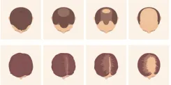 baldness-predictor